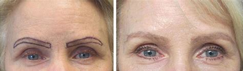 Los angeles hair replacement systems and toupees for men and women. Eyebrow transplant Los Angeles