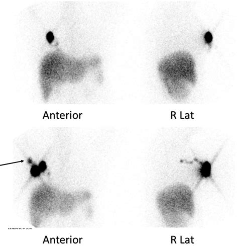 Lymphoscintigraphy Images Of The Patient No Sentinel Node