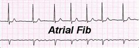 Atrial Fibrillation By Dr John M Rate Control Rhythm Control