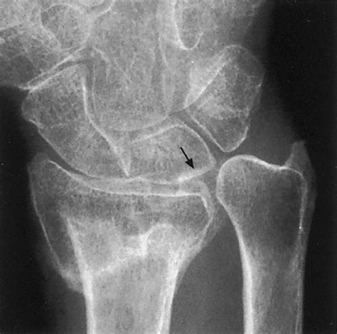 Imaging Findings In Ulnar Sided Wrist Impaction Syndromes Radiographics
