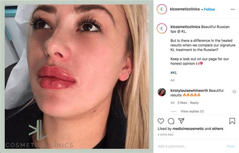 Russian Lips The Trending Lip Filler Technique Kl Cosmetics Clinic