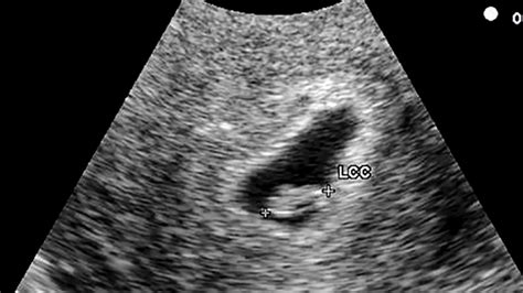 Your 6 Week Ultrasound What You Can Expect To See