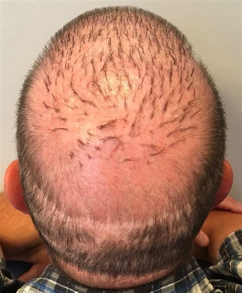 Donor Beard Hair For Scalp Hair Transplant Marc Dauer Md Hair