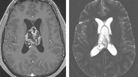 Ventricular Tumors The Neurosurgical Atlas