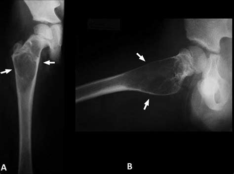 12 Year Old Boy Radiograph Of The Right Hip In Anteroposterior Ap