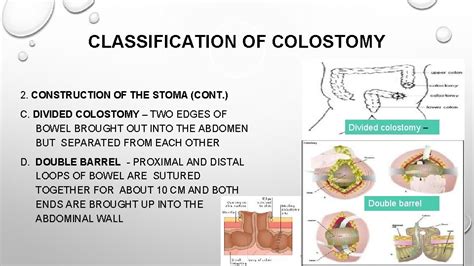 Outline Endoscopy Indications Contraindications Complications Nursing Responsibilities Colostomy