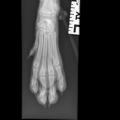Clinical Tip Metacarpal And Metatarsal Fractures Spider Frame