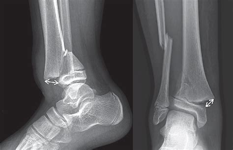 Distal Tibia Fracture