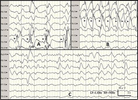 Bilateral Independent Periodic Lateralized Epileptiform Discharges With