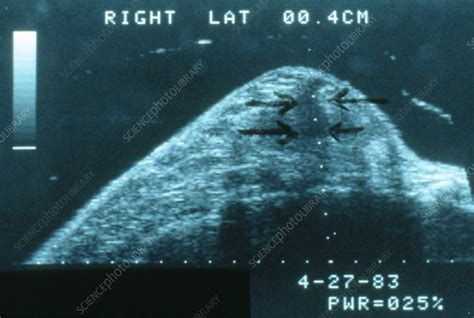 Ultrasound Scan Of Womans Breast Cancer Stock Image M1220047