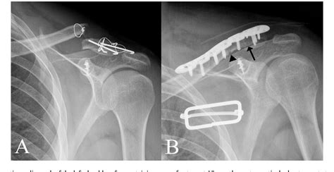 Modified Tension Band Fixation And Coracoclavicular Stabilisation For