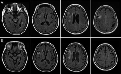 T2 Flair Axial Brain Mri Shows Evolution Of Cerebral Infarcts At Onset