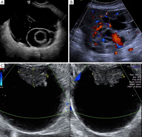 Figure 2 From Imaging And Diagnostic Approach Of The Adnexal Mass What
