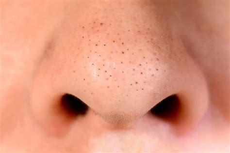 Removing Blackheads The Best And Worst Approaches