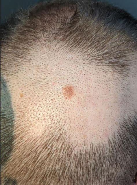 Diagnosed With Stage 1a Melanoma Today Picture Melanoma