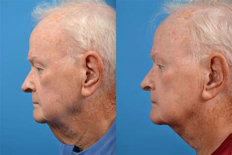 patient 122406456 profile neck lift before and after photos clevens face and body specialists