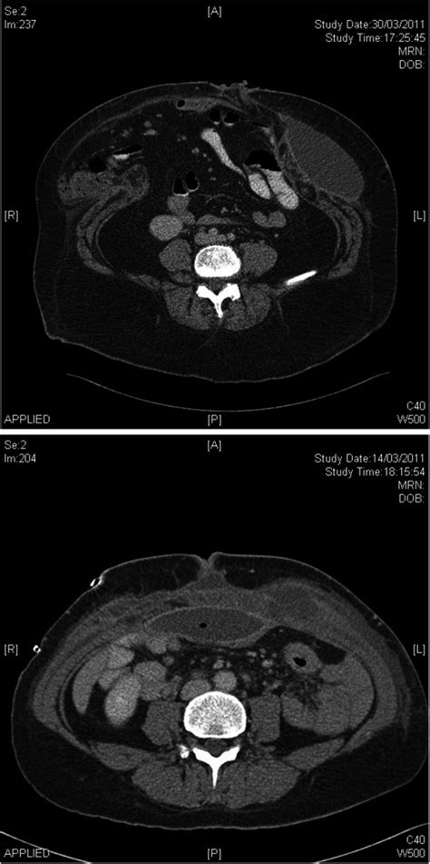 Ct Scan Images Of I Top Image Complete Rupture Of An Incisional