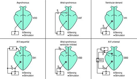 Cardiac Pacing And Implantable Cardioverterdefibrillators Clinical Gate