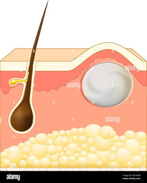 Cysts Acne Cut Out Stock Images And Pictures Alamy