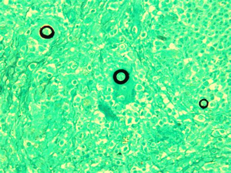 June 09 Coccidioides Precision Pathology
