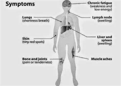 Sign And Symptoms Of Hodgkins Lymphoma Pt Master Guide