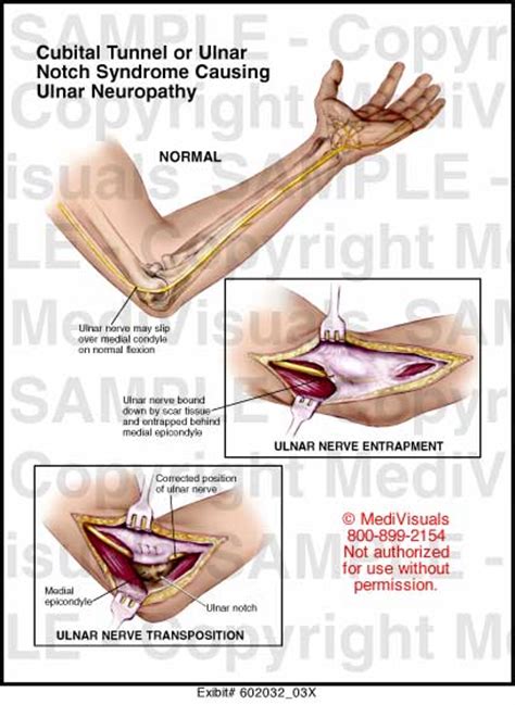 Medivisuals Cubital Tunnel Or Ulnar Notch Syndrome Causing Ulnar