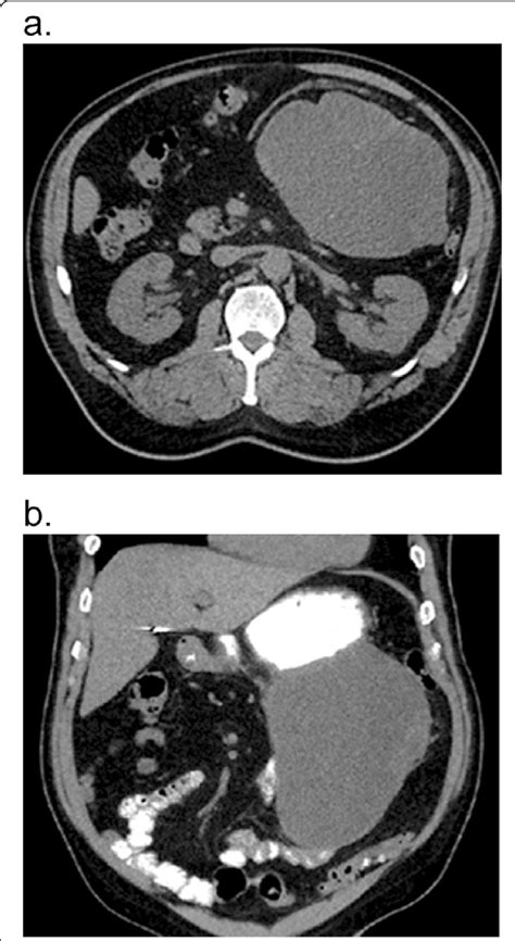Ct Scan Of Gastrointestinal Stromal Tumor Gist Prior To Surgery A