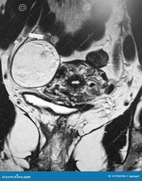 Teratoma Rare Ovarian Pathology Mri Exam Stock Photo Image Of Cancer