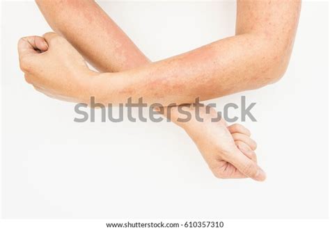 Skin Rashes Allergies Contact Dermatitis Allergic Stock Photo 610357310