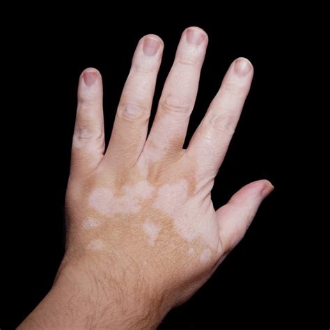 Effects Of Skin Bleaching Livestrongcom