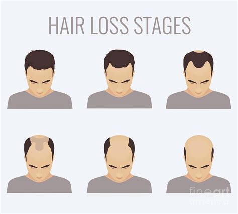 Male Pattern Baldness Stages By Art4stockscience Photo Library