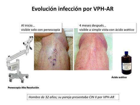 El VPH Virus del Papiloma Humano la ITS más común en hombres