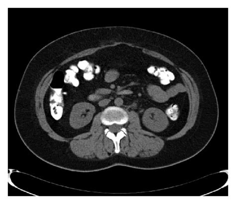 Abdominal Computed Tomography Ct Scan One Year After The Operation