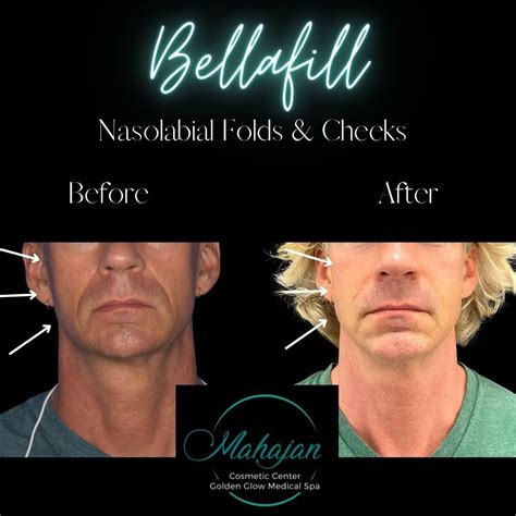 Ace Your Lower Face Before And After With Bellafill In Nasolabial Folds