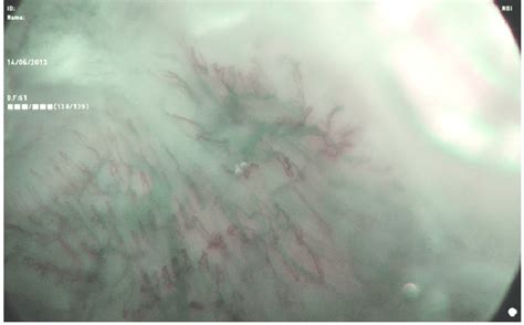 Nbi Image Of Squamous Cell Carcinoma On Soft Palate Type Iv Pattern