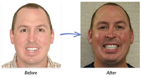 Before And After Braces Photos Delurgio Orthodontics