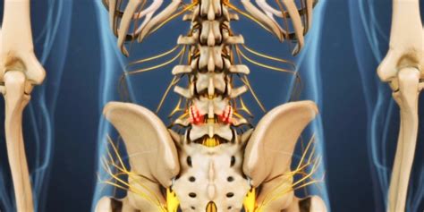 Is Your Bulging Disk Causing Your Back Pain Legacy Spine