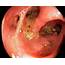 Diverticular Disease In The Colon Photograph By Gastrolab/science Photo 