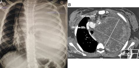 Primary Synovial Sarcoma Of The Mediastinum A Poor Prognosis In A 14