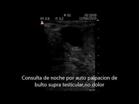 Quiste De Epididimo Ecografia Vscan Dual Urologia YouTube