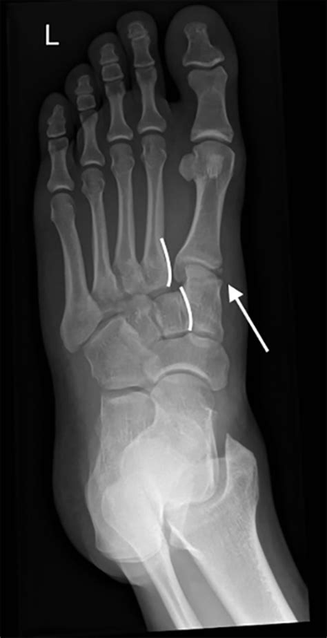 A Painful Foot Lisfranc Fracture Dislocations The Bmj