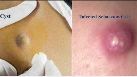Sebaceous Cyst Causes And Treatment Root Care Dental Skin And Hair
