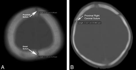 Normal Sagittal And Coronal Suture Widths By Using Ct Imaging