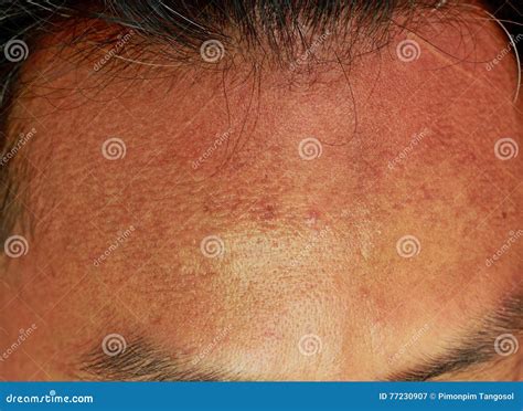 Acne Forehead Stock Image Image Of Inflammation Pizzaface 77230907