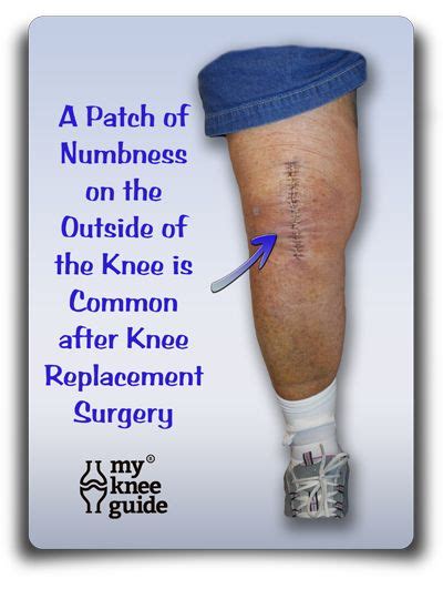 104 Best Knee Replacement Recovery Images In 2020 Knee Replacement