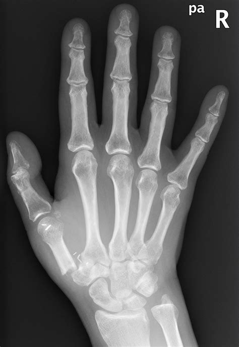 X Ray Hand Normal Images Galleries With A Bite