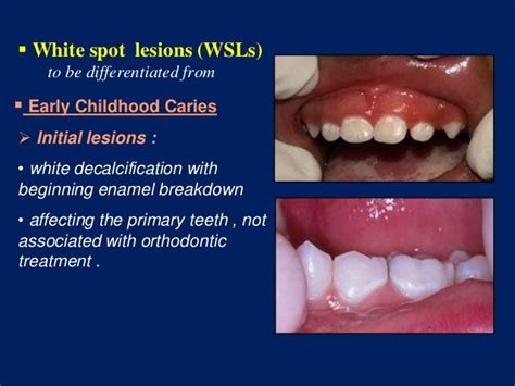 Treatment Of White Spot Lesions On Teeth Teeth Poster