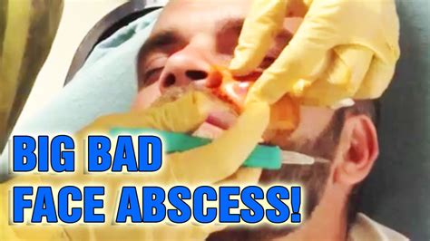 Staph And Mrsa Infected Face Dr Er Drains Abscess 👌😷 Youtube