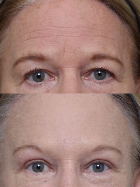 Eyelid Surgery Before And After Brian Biesman Md