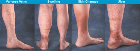 Understanding Vein Disease San Diego Skin And Vein Laser Clinic